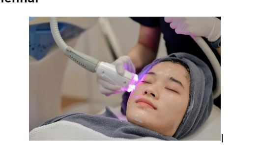 Exploring The Benefits Of Skin Laser Treatment In Chennai
